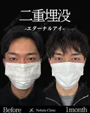 Dr岩切💝二重埋没💝 before画像 サムネイル用