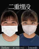 Dr岩切💝二重埋没💝 before画像 サムネイル用
