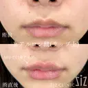 【唇ヒアル】ふっくら唇で人中短縮 before画像 サムネイル用