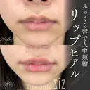 【唇ヒアル】ふっくら唇で人中短縮 after画像 サムネイル用