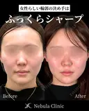 🌟Dr都築🌟小顔カスタマイズ before画像 サムネイル用