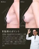 しっかりサイズアップしたのに美しく馴染む胸元✨｜プレミアムハイブリッド豊胸 after画像 サムネイル用