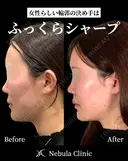 🌟Dr都築🌟小顔カスタマイズ after画像 サムネイル用