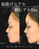 額ヒアルロン酸 after画像 サムネイル用
