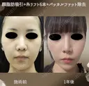 サクションリフト＋バッカルファット除去 365日後 サムネイル用