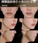 サクションリフト 120日後 サムネイル用