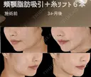 サクションリフト 90日後 サムネイル用