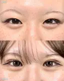 二重埋没＋ before画像 サムネイル用
