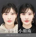 オンダリフト(頬) ＋ボツリヌストキシン注射(エラ) before画像 サムネイル用