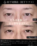 【40代男性・1か月後】眉下切開法（眉下リフト） before画像 サムネイル用