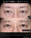 【40代男性・1か月後】眉下切開法（眉下リフト） 30日後 サムネイル用