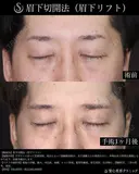 【40代男性・1か月後】眉下切開法（眉下リフト） 30日後 サムネイル用