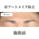 アートメイク除去 before画像 サムネイル用