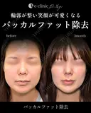バッカルファット after画像 サムネイル用