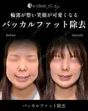 バッカルファット before画像 サムネイル用