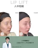 人中短縮（リップリフト） 180日後 サムネイル用