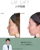 人中短縮（リップリフト） 180日後 サムネイル用