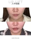 人中短縮（リップリフト） 180日後 サムネイル用