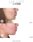 人中短縮（リップリフト） 180日後 サムネイル用