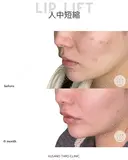 人中短縮（リップリフト） after画像 サムネイル用