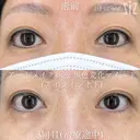【アートメイク除去】25年ものアイライン before画像 サムネイル用