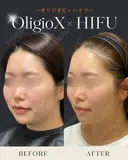 オリジオX+ウルトラセルZiリニアハイフ before画像 サムネイル用