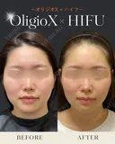 オリジオX+ウルトラセルZiリニアハイフ after画像 サムネイル用