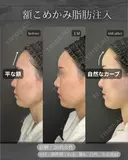 脂肪注入(額、こめかみ) after画像 サムネイル用