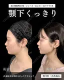 顔の脂肪吸引 before画像 サムネイル用