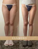 太もも脂肪吸引 90日後 サムネイル用