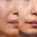ジュブゼン after画像 サムネイル用