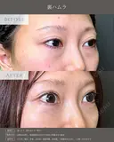 【クマ治療】裏ハムラ法 after画像 サムネイル用