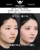 鼻中隔延長・鼻尖形成・貴族手術・眼瞼下垂・目頭切開・目上切開・頬ヒアルロン酸・糸リフト before画像 サムネイル用