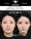 鼻中隔延長・鼻尖形成・貴族手術・眼瞼下垂・目頭切開・目上切開・頬ヒアルロン酸・糸リフト 30日後 サムネイル用