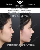 鼻中隔延長・鼻尖形成・貴族手術・眼瞼下垂・目頭切開・目上切開・頬ヒアルロン酸・糸リフト 30日後 サムネイル用