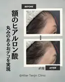 丸みのあるおでこを実現！ after画像 サムネイル用