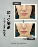 頬こけ解消！滑らかな輪郭を！ before画像 サムネイル用