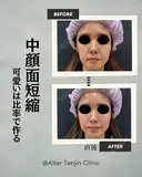 可愛いは比率でつくる💕 中顔面短縮ヒアルロン酸 before画像 サムネイル用