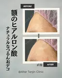額のヒアルロン酸でナチュラルなつるんおでこ after画像 サムネイル用