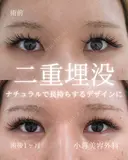 二重埋没 before画像 サムネイル用