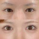 目の下のクマ取り before画像 サムネイル用