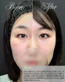 【クマ治療】裏ハムラ法 before画像 サムネイル用