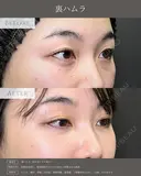 【クマ治療】裏ハムラ法 after画像 サムネイル用