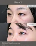 【クマ治療】裏ハムラ法 after画像 サムネイル用
