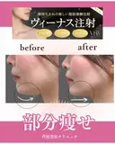 ヴィーナス注射（顔用脂肪溶解注射） before画像 サムネイル用