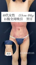 シークレット脂肪吸引お腹まわり before画像 サムネイル用