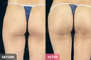 ブラジリアンバットリフト before画像 サムネイル用