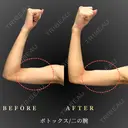二の腕ボトックス 60日後 サムネイル用