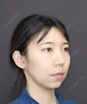 裏ハムラ＋MFL＋頬・顎下の脂肪吸引＋SL12本＋脂肪注入(頬・目の下・マリオネット) before画像 サムネイル用