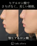 【ヒアルロン酸注入】顎ヒアルロン酸 after画像 サムネイル用